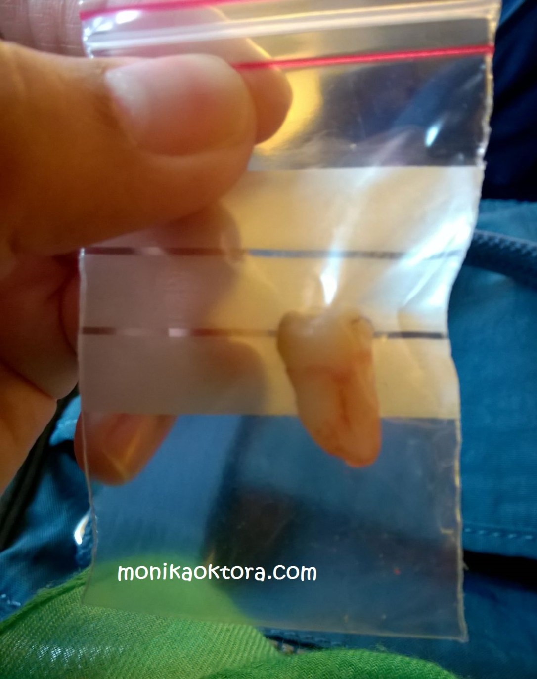Wisdom teeth yang dicabut